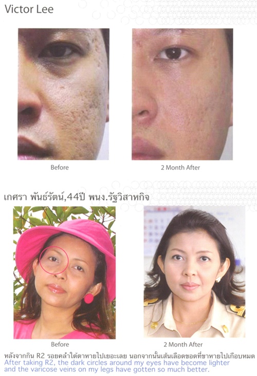 อาร์แสควร์ช่วยให้ผิวพรรณดีขึ้น