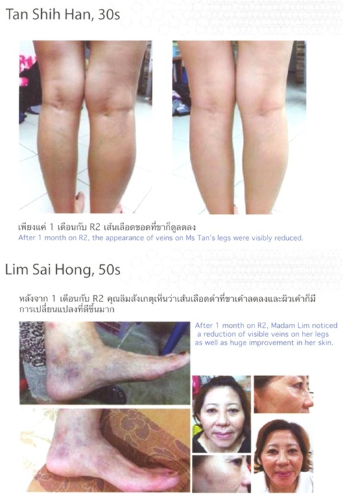 อาร์สแควร์แก้ปัญหาเส้นเลือดขอด