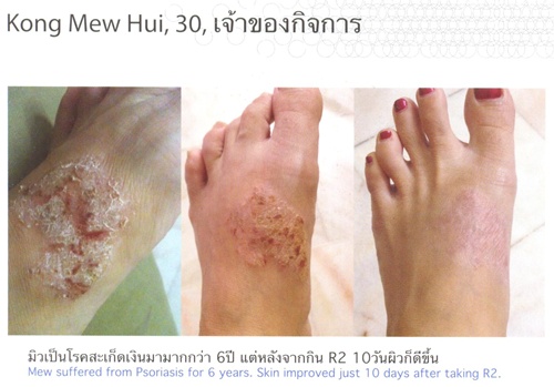อาร์สแควร์แก้ปัญหาผิว